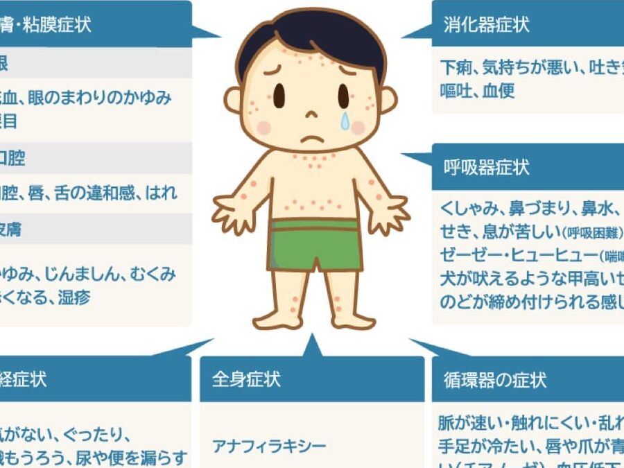 いくらアレルギーの症状と治療法について知ること